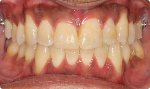 after severe crowding deep overbite