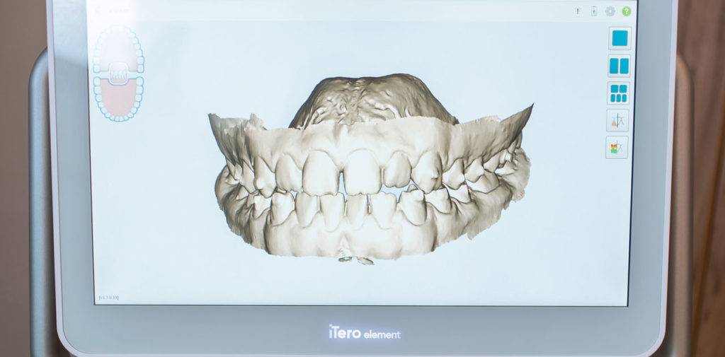 3d teeth scan